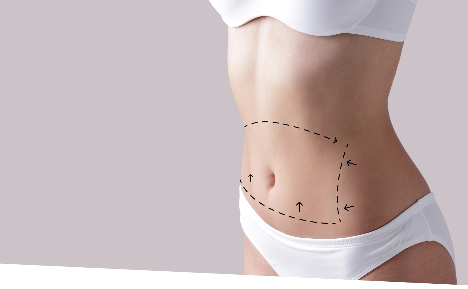 Illustration of liposuction procedure markings